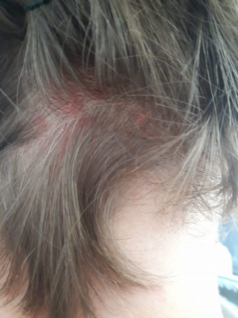 présence de la dermatite sur la tête