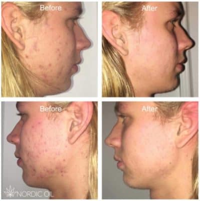 CBD para a acne