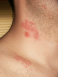 Shingles or herpes zoster