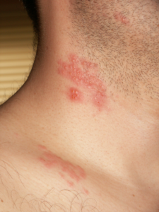 Hemppedia 1 Shingles or herpes zoster