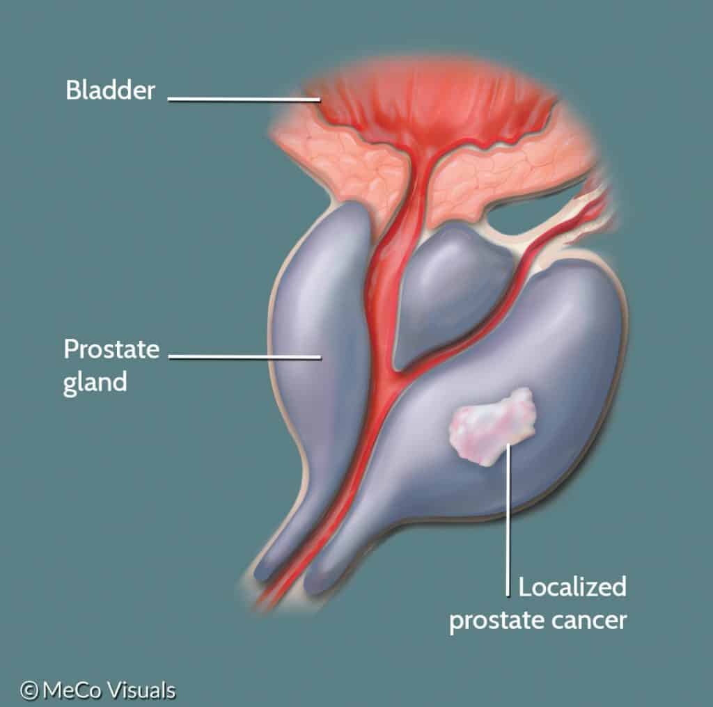 Cancro da próstata localizado